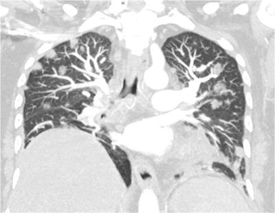 A Case Report and Review of the Literature: Infectious Aneurysm Formation in the Pulmonary Arteries—A Rare but Perilous Sequela of Persisting Infection With Klebsiella pneumoniae